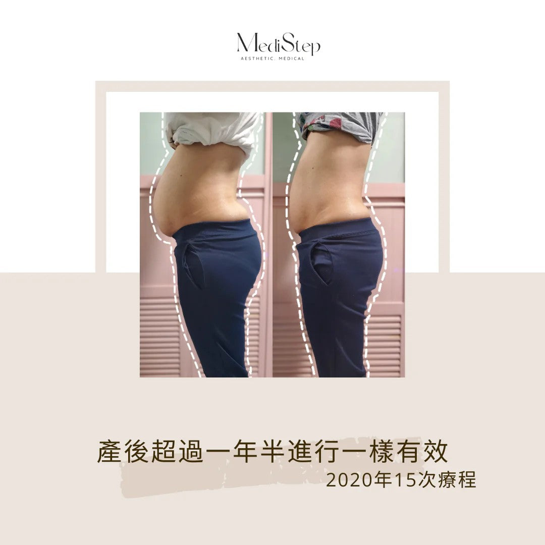 AeStep 獨家『九步束腹術』